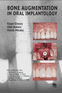 Bone Augmentation in Oral Implantology