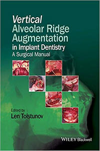 Vertical Alveolar Ridge Augmentation in Implant Dentistry: A Surgical Manual