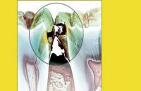 Dental Caries: The Disease and Its Clinical Management, 3rd Edition