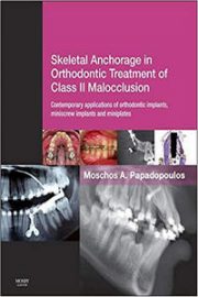 Skeletal Anchorage in Orthodontic Treatment of Class II Malocclusion