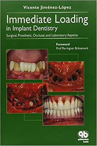 Immediate Loading in Implant Dentistry