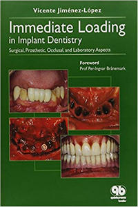 Immediate Loading in Implant Dentistry