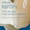 RBFDPs: Resin-Bonded Fixed Dental Prostheses