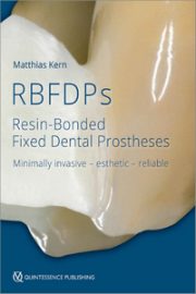 RBFDPs: Resin-Bonded Fixed Dental Prostheses