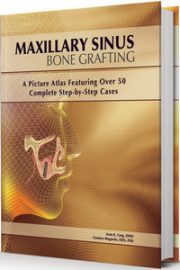 Maxillary Sinus Bone Grafting: A Picture Atlas Featuring over 50 Complete Step-By-Step Cases