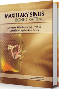 Maxillary Sinus Bone Grafting