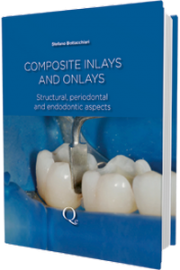 Composite Inlays and Onlays: Structural, Periodontal, and Endodontic Aspects