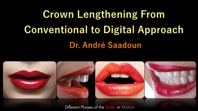 Crown Lengthening From Conventional to Digital Approach