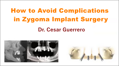 How to Avoid Complications in Zygoma Implant Surgery