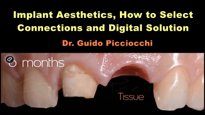 Implant Aesthetics, How to Select Connections and Digital Solution