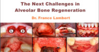 The Next Challenges in Alveolar Bone Regeneration