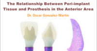 The Relationship Between Peri-implant Tissue and Prosthesis in the Anterior Area