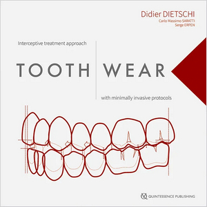 Tooth Wear: Interceptive Treatment Approach with Minimally Invasive Protocols